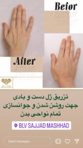 نمونه کار تزریق ژل (دکتر اعظم خانزاده)