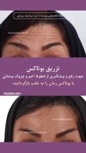 نمونه تزریق بوتاکس کلینیک نواوران زیبایی