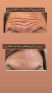 نمونه تزریق بوتاکس (دکتر الهه مولوی)