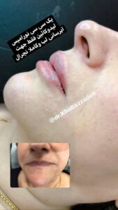 نمونه کار تزریق ژل (دکتر مریم خباززاده)