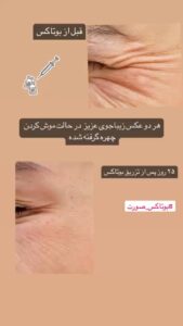 نمونه تزریق بوتاکس (دکتر الهه مولوی)