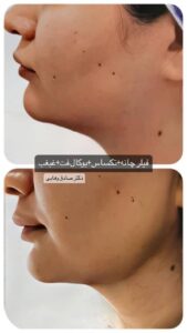 نمونه کار تزریق ژل (کلینیک سلامت ایده آل)