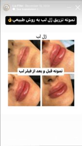 نمونه کار تزریق ژل (کلینیک سلامت ایده آل)