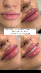 نمونه کار تزریق ژل (کلینیک سلامت ایده آل)