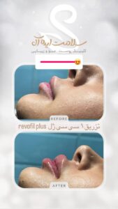 نمونه کار تزریق ژل (کلینیک سلامت ایده آل)