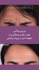 نمونه تزریق بوتاکس کلینیک نواوران زیبایی