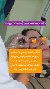 نمونه کار تزریق بوتاکس (کلینیک زیبایی سی گل)