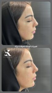 نمونه کار تزریق ژل (دکتر ژل)