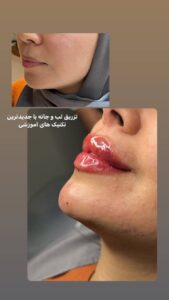 نمونه کار تزریق ژل (دکتر اعظم خانزاده)