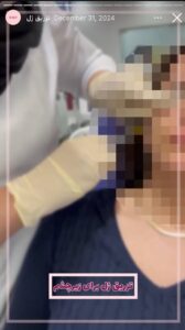 نمونه کار تزریق ژل دکتر الهه اندخشیده در مشهد