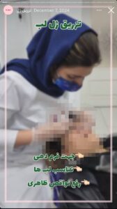 نمونه کار تزریق ژل دکتر الهه اندخشیده در مشهد