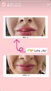 نمونه کار تزریق ژل دکتر الهه اندخشیده در مشهد