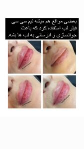 نمونه کار تزریق ژل (کلینیک سلامت ایده آل)