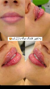 نمونه کار تزریق ژل (کلینیک سلامت ایده آل)