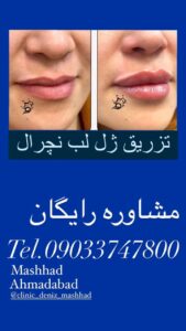 نمونه کار تزریق ژل (کلینیک زیبایی دنیز)