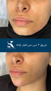 نمونه کار تزریق ژل (دکتر ژل)