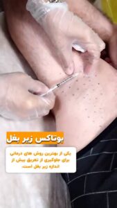 نمونه کار تزریق بوتاکس (کلینیک زیبایی سی گل)