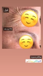 نمونه تزریق بوتاکس (دکتر الهه مولوی)