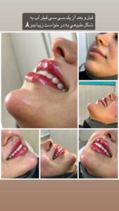 نمونه کار تزریق ژل (کلینیک سلامت ایده آل)