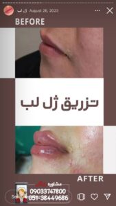 نمونه کار تزریق ژل (کلینیک زیبایی دنیز)