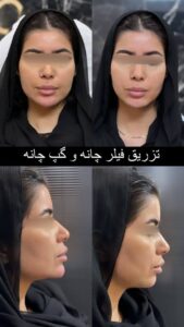 نمونه کار تزریق ژل (دکتر ژل)