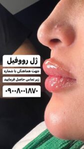 نمونه کار تزریق ژل (دکتر محمد بهبودی فرد)