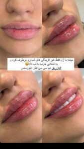 نمونه کار تزریق ژل (کلینیک سلامت ایده آل)