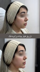 نمونه کار تزریق ژل (دکتر ژل)