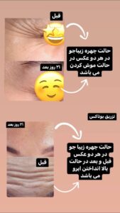 نمونه تزریق بوتاکس (دکتر الهه مولوی)