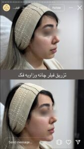 نمونه کار تزریق ژل (دکتر ژل)