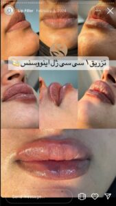 نمونه کار تزریق ژل (کلینیک سلامت ایده آل)