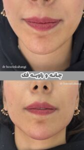 نمونه کار تزریق ژل (دکتر ژل)