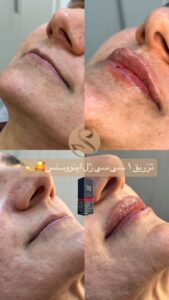 نمونه کار تزریق ژل (کلینیک سلامت ایده آل)