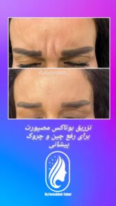 نمونه کار تزریق بوتاکس (دکتر فرشته طاهر)