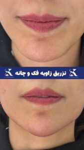 نمونه کار تزریق ژل (دکتر ژل)