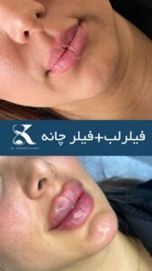 نمونه کار تزریق ژل (دکتر ژل)