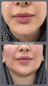 نمونه کار تزریق ژل (دکتر ژل)