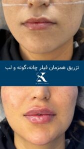 نمونه کار تزریق ژل (دکتر ژل)