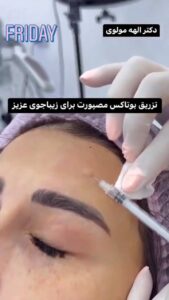 نمونه تزریق بوتاکس (دکتر الهه مولوی)