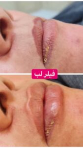 نمونه کار تزریق ژل (کلینیک زیبایی نوین ایرانا)