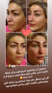 نمونه کار تزریق ژل (دکتر مریم خباززاده)