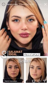 نمونه کار تزریق ژل (کلینیک سلامت ایده آل)