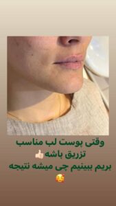 نمونه کار تزریق ژل (دکتر اعظم خانزاده)