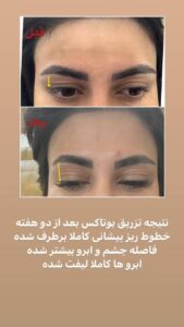 نمونه کار تزریق بوتاکس (دکتر فرشته طاهر)