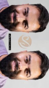 نمونه کار تزریق بوتاکس (کلینیک سلامت ایده ال)