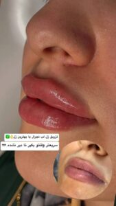 نمونه کار تزریق ژل (کلینیک زیبایی دنیز)