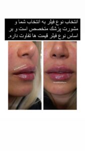 نمونه کار تزریق ژل (کلینیک سلامت ایده آل)