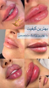 نمونه کار تزریق ژل (کلینیک زیبایی دنیز)