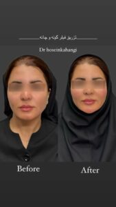 نمونه کار تزریق ژل (دکتر ژل)