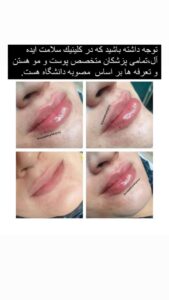 نمونه کار تزریق ژل (کلینیک سلامت ایده آل)